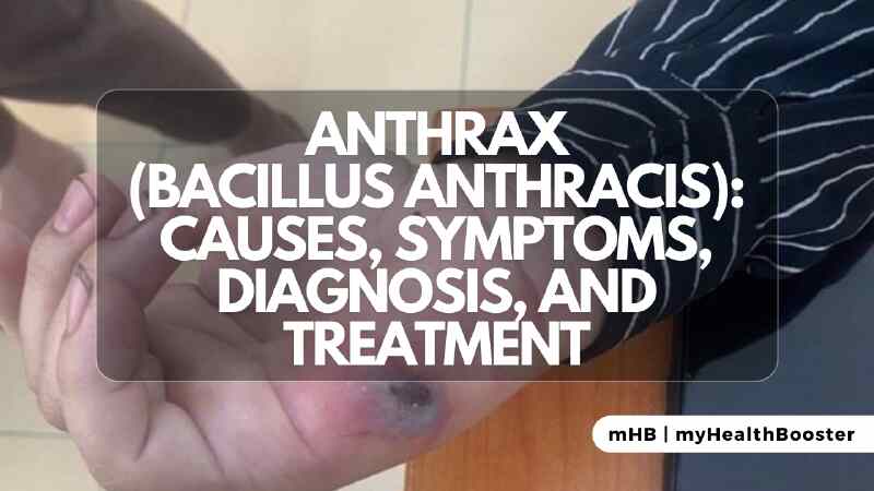 Anthrax (Bacillus Anthracis) Causes, Symptoms, Diagnosis, and Treatment