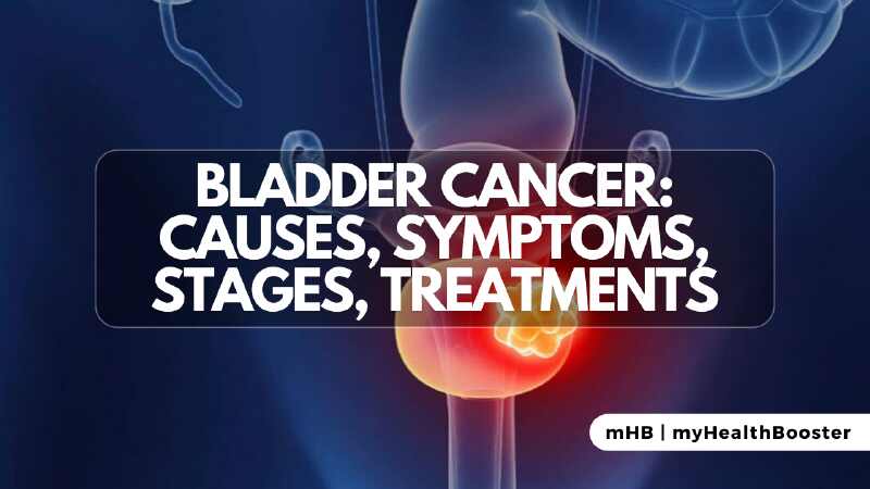 Bladder Cancer: Causes, Symptoms, Stages, Treatments
