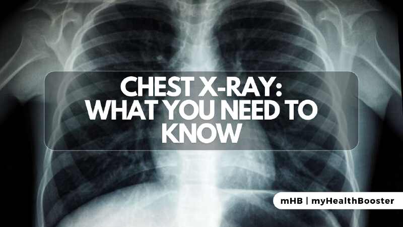 Chest X-ray: What you need to know