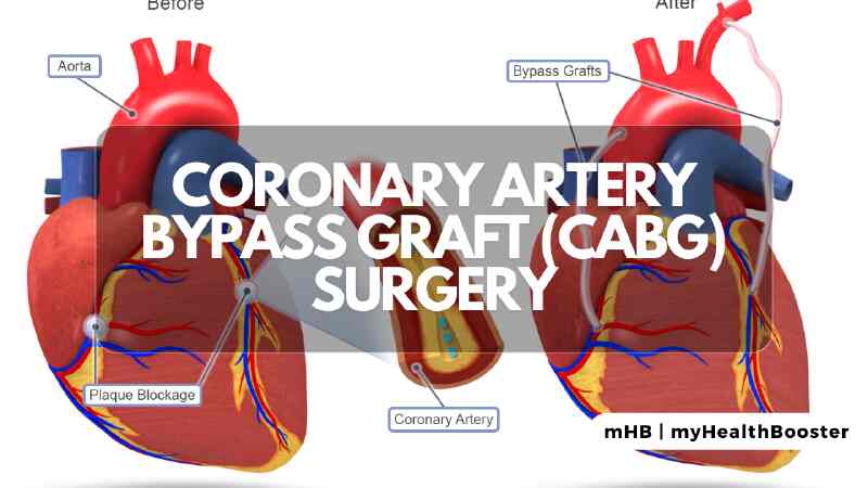 Coronary Artery Bypass Graft (CABG) Surgery