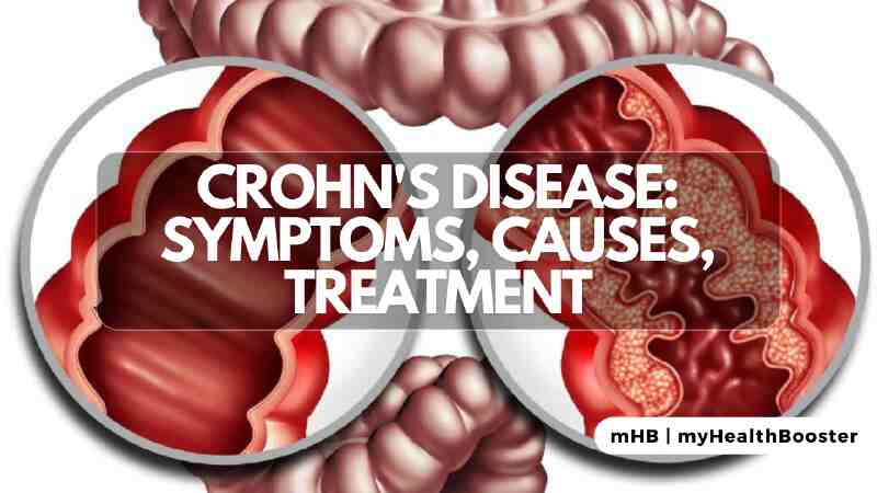 Crohn's Disease: Symptoms, Causes, Treatment