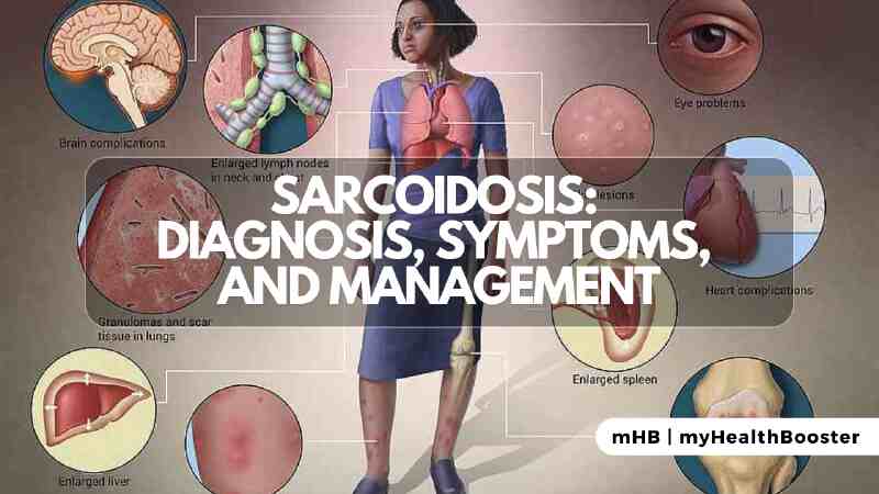 Sarcoidosis: Diagnosis, Symptoms, and Management